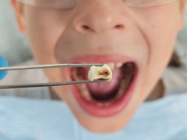 Best Emergency Dental Care for Broken or Chipped Teeth in Butler, OH